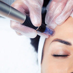 Microneedling